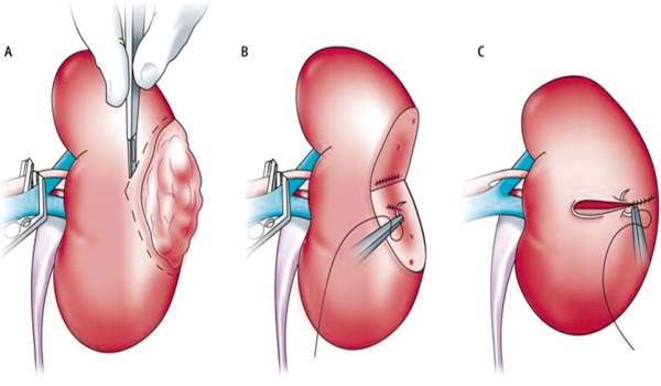 Uro Oncology