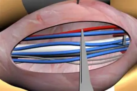 Microscopic Varicocelectomy