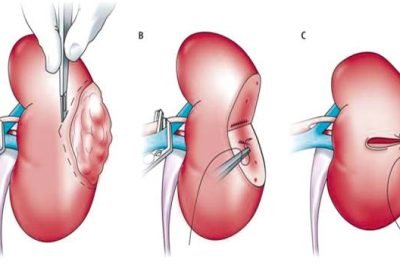 Uro Oncology