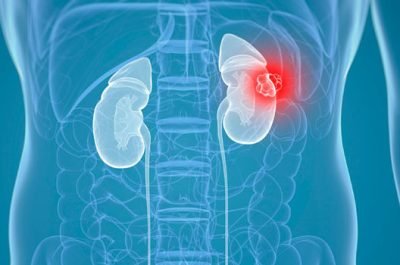 Kidney Transplant treatment in Lahore Pakistan